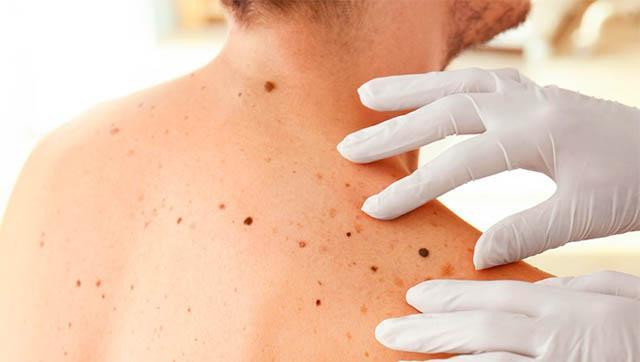 Prevención y concientización: llega Salvá tu Piel a Morón